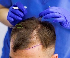 Клиника HFE безоперационная пересадка волос